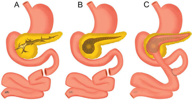 Frey Procedure